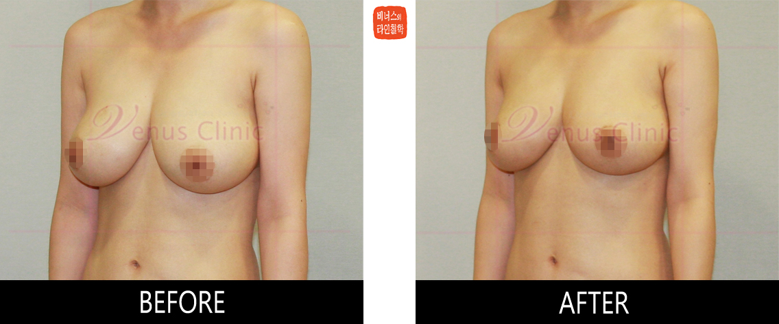 breast_liposuction-2.jpg