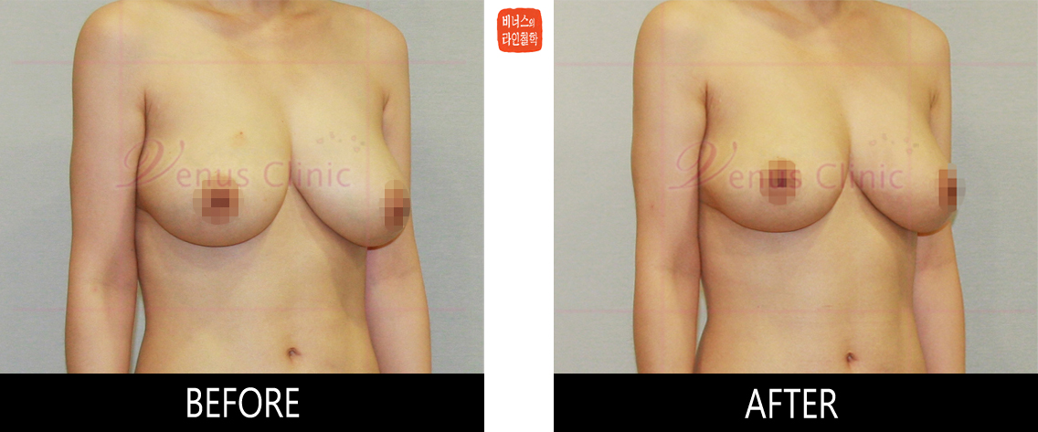 breast_liposuction-4.jpg