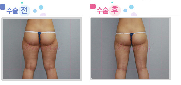 엉덩이와 허벅지 지방흡입 전후사진2
