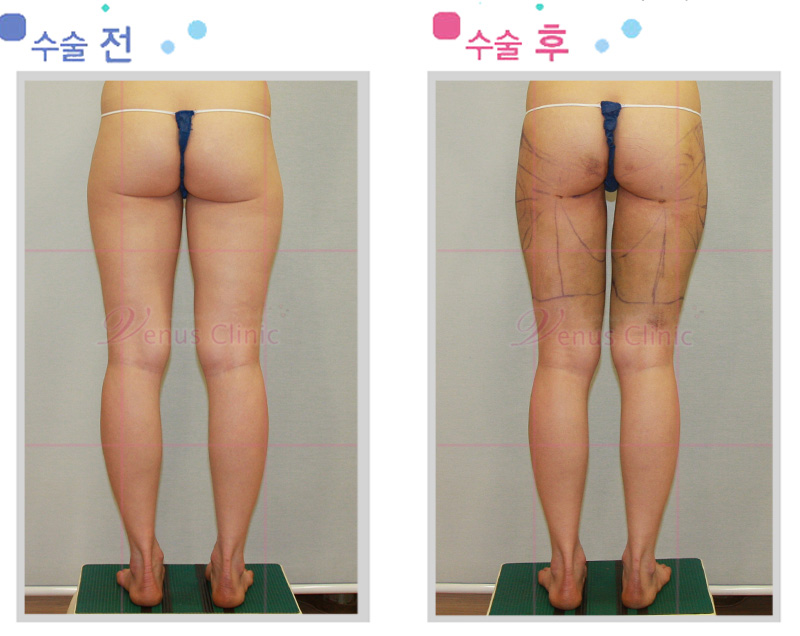 지방흡입후 멍, 붓기