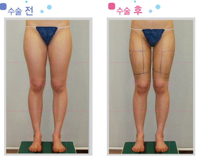 지방흡입후 멍과 붓기