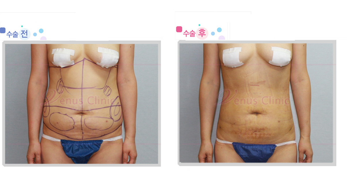 abdomen_1wk.jpg