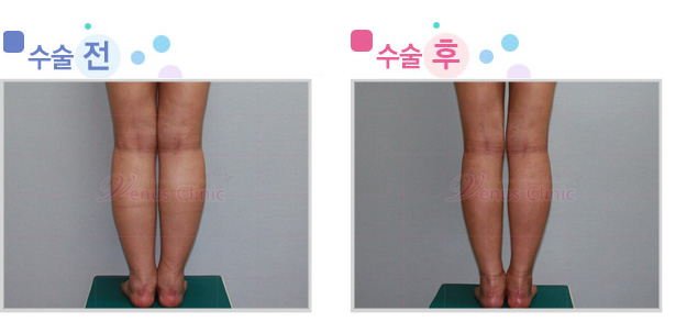 종아리 지방흡입 전후사진 종아리 지방흡입 전후사진