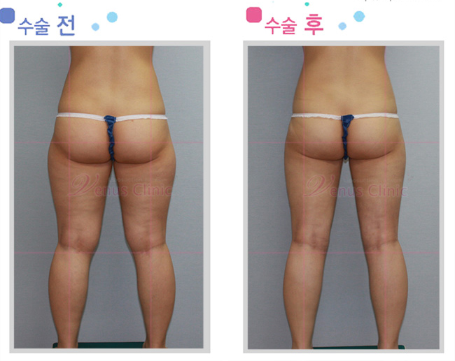 외측 허벅지 지방흡입 전후사진 외측 허벅지 지방흡입 전후사진