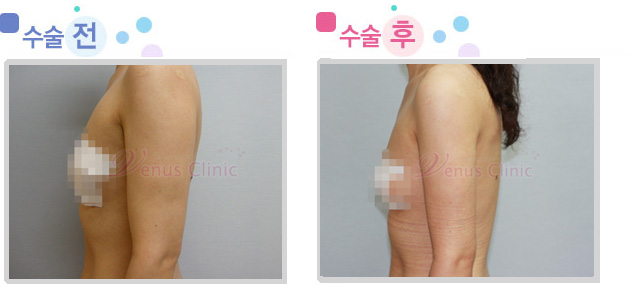 후측 팔 지방흡입 전후사진 후측 팔 지방흡입 전후사진