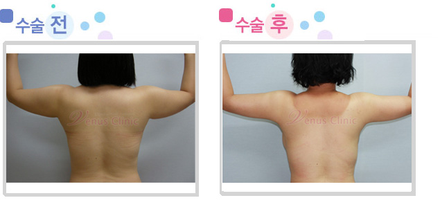겨드랑이 지방흡입 전후사진 겨드랑이 지방흡입 전후사진