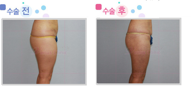 전측 허벅지 지방흡입 전후사진 전측 허벅지 지방흡입 전후사진