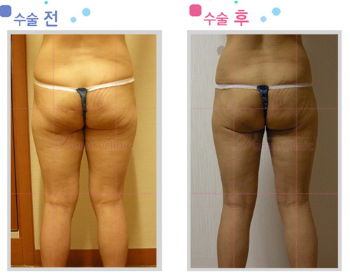 힙,엉덩이 지방흡입 전후사진1