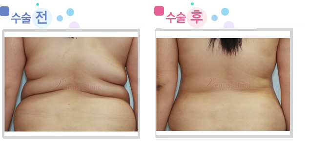 브라라인 지방흡입 전후사진 브라라인 지방흡입 전후사진