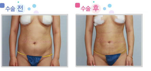 복부 지방흡입 전후사진1 복부 지방흡입 전후사진1