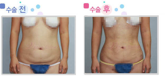 복부 지방흡입 전후사진2 복부 지방흡입 전후사진2