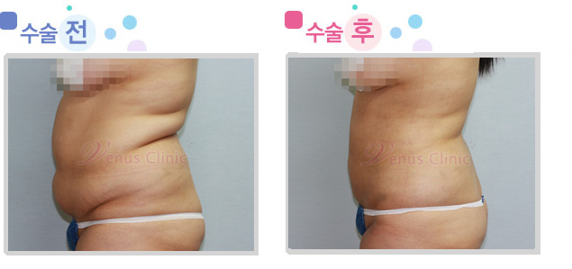 상복부/하복부 지방흡입 전후사진 상복부/하복부 지방흡입 전후사진