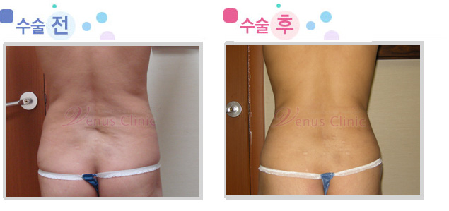 옆구리 지방흡입 전후사진 옆구리 지방흡입 전후사진