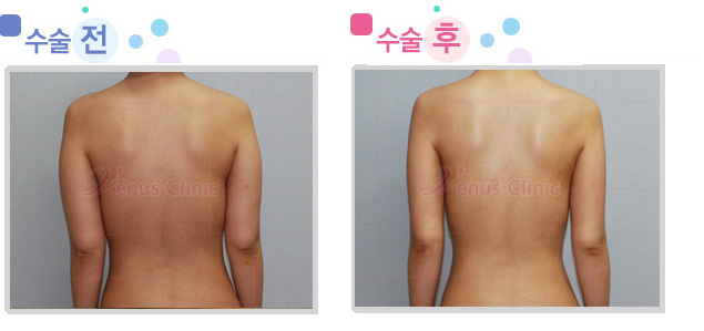 외측 팔 지방흡입 전후사진 외측 팔 지방흡입 전후사진