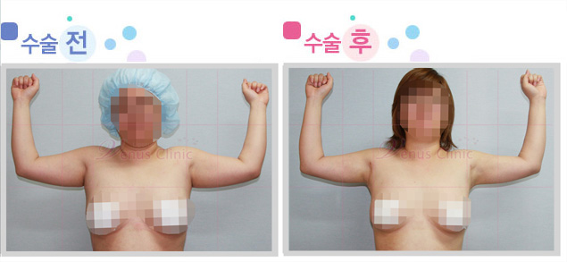 팔 지방흡입 전후사진 팔 지방흡입 전후사진
