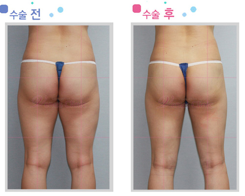 무릎지방흡입 전후사진 무릎지방흡입 전후사진