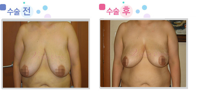 가슴지방흡입 전후사진 가슴지방흡입 전후사진