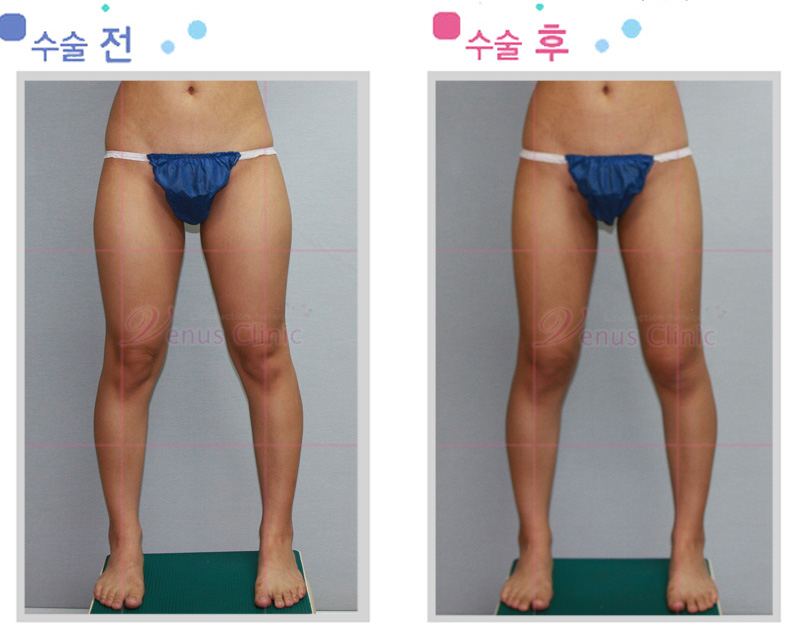 전체 허벅지 지방흡입 전후사진1 전체 허벅지 지방흡입 전후사진1