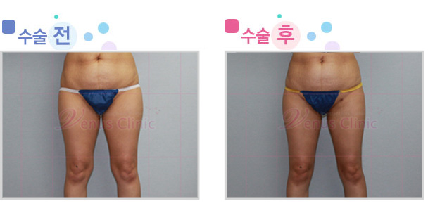 내측 허벅지 지방흡입 전후사진 내측 허벅지 지방흡입 전후사진