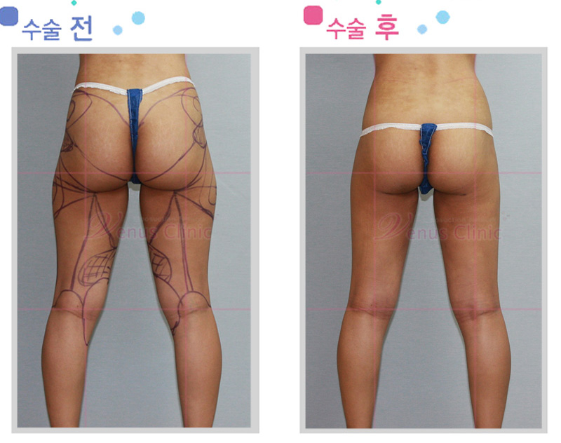 전체 허벅지 지방흡입 전후사진2 전체 허벅지 지방흡입 전후사진2