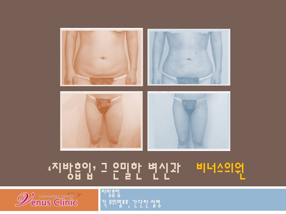 지방흡입 그 은밀한 변신과 비너스의원 지방흡입 그 은밀한 변신과 비너스의원