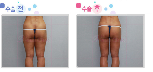 엉덩이와 허벅지 지방흡입 전후사진1