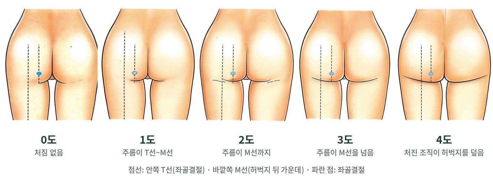 엉덩이 처짐 0도~4도 뒷모습