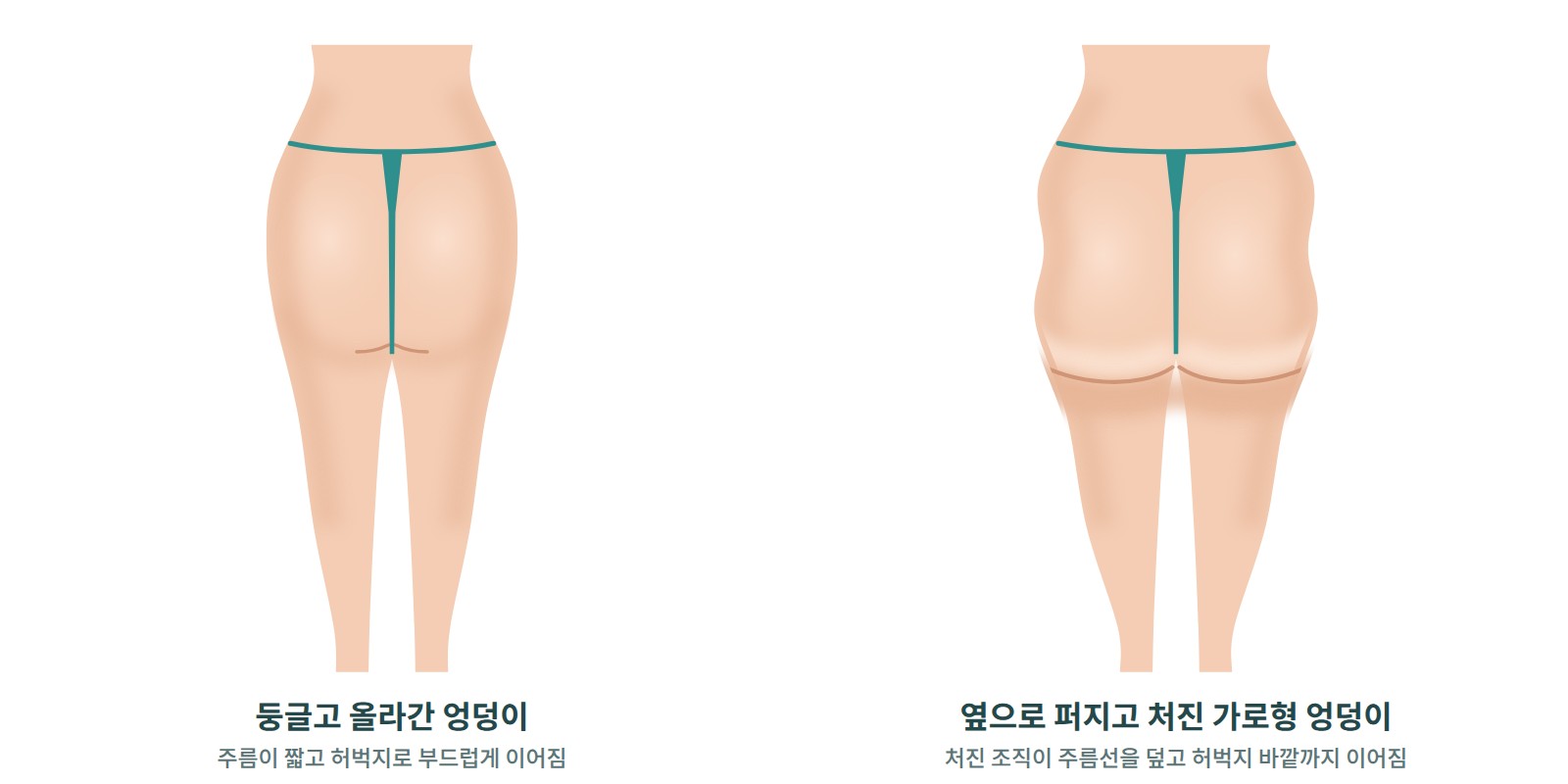탄력 있게 올라간 엉덩이와 옆으로 퍼지며 처진 엉덩이의 뒷모습 비교
