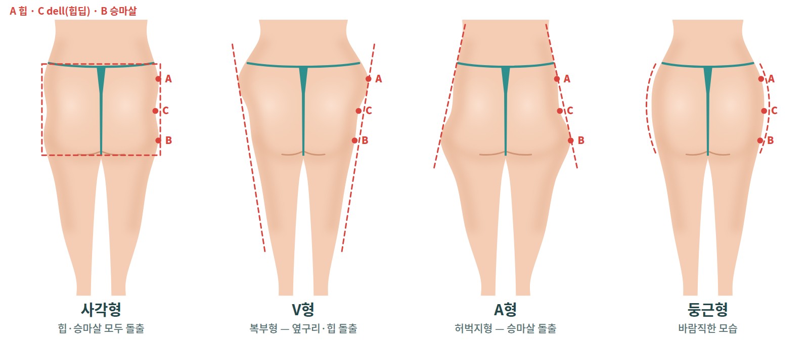 뒤에서 본 엉덩이의 네 가지 형태 도해 — 사각형, V형, A형, 둥근형과 힙(A)·dell(C)·승마살(B) 점