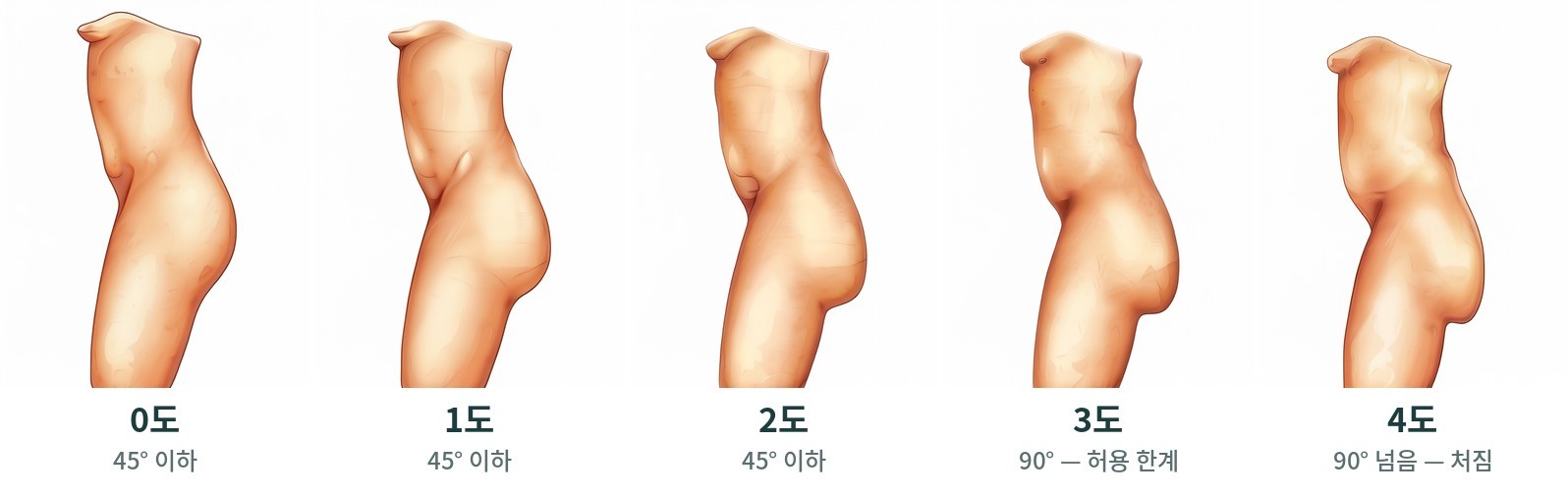 옆에서 본 엉덩이 처짐 단계 0도~4도