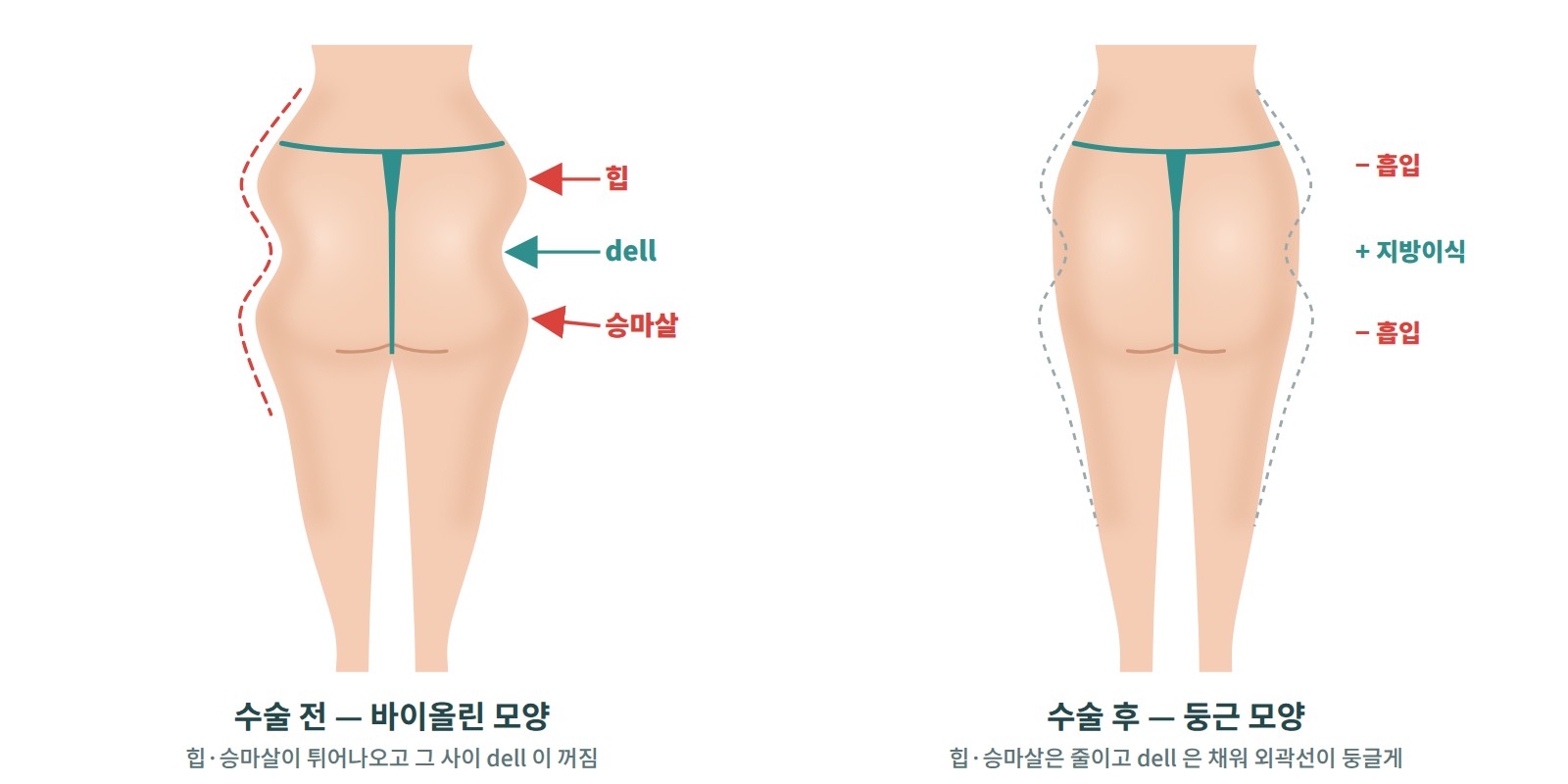 힙·엉덩이·승마살을 함께 수술한 가상 전후 뒷모습