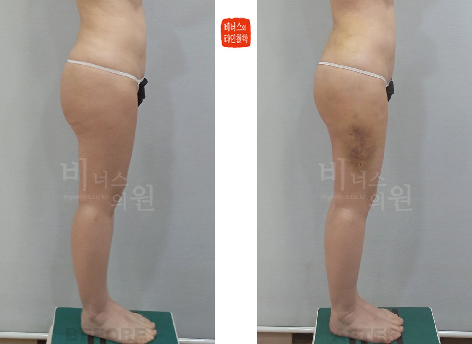 엉덩이·허벅지 지방흡입 재수술 전후사진 두 번째 케이스 측면