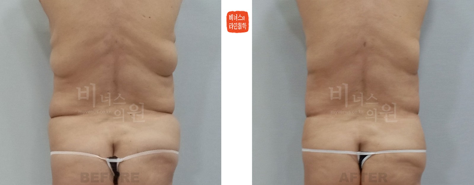 복부 지방흡입 재수술 전후사진 첫 번째 케이스 후면