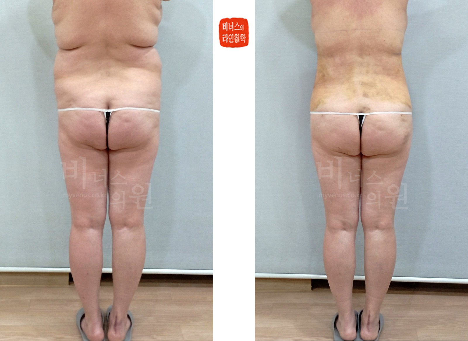 복부·등 지방흡입 전후사진 후면 (수술 후 1주)