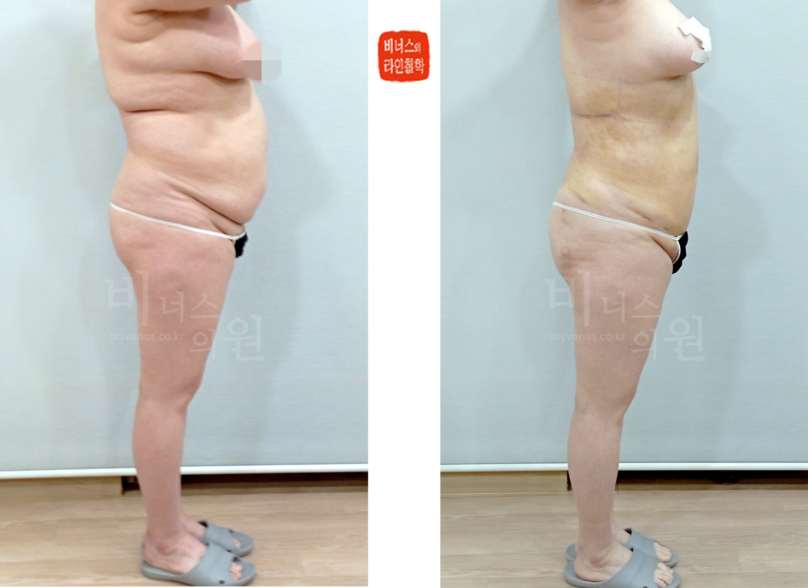 복부 지방흡입 전후사진 측면 2 (수술 후 1주)