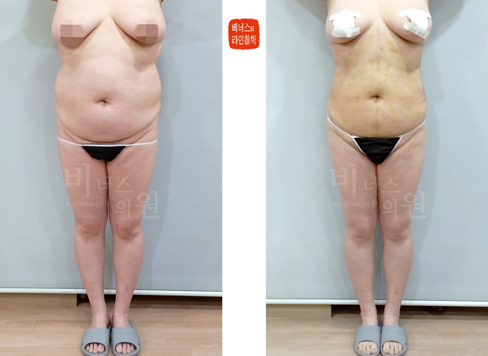 복부 지방흡입 전후사진 정면 (수술 후 1주)