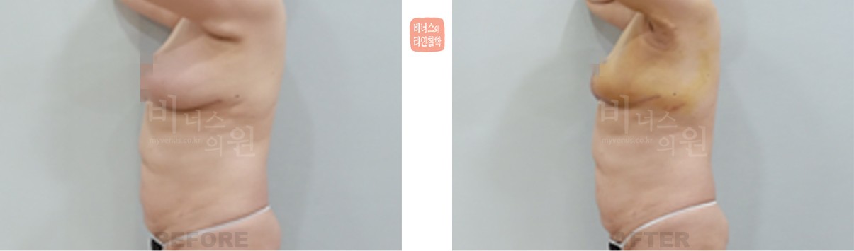 유방 절제술 이후 지방흡입 유방축소 전후사진 좌측면 (수술 후 1주일)