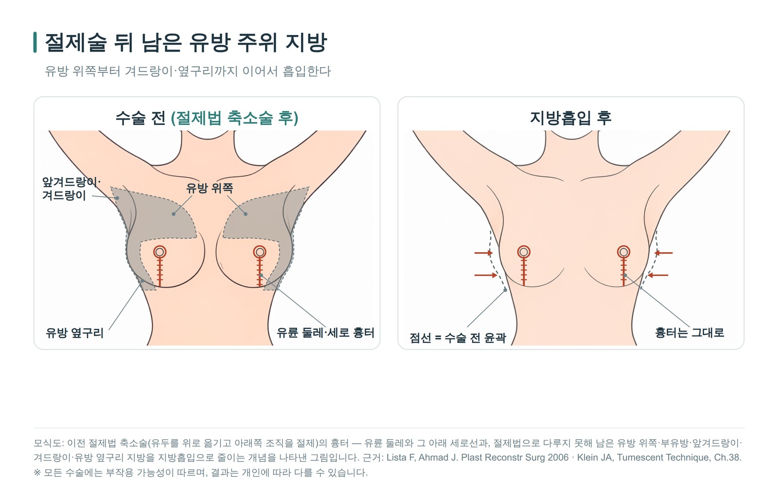 절제법 축소술의 세로 흉터와 지방흡입으로 줄인 유방 위쪽·부유방·앞겨드랑이·유방 옆구리 범위를 나타낸 모식도
