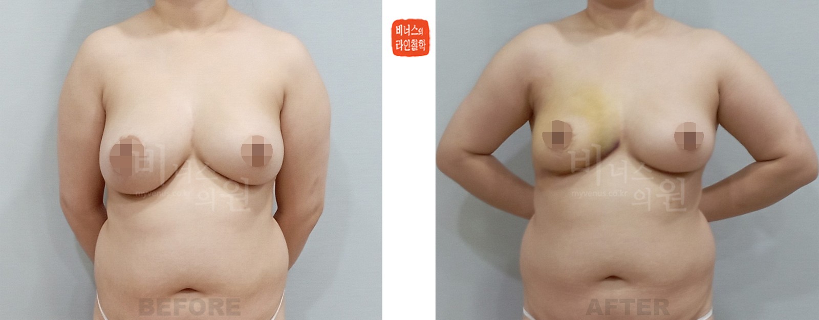 짝가슴 교정 지방흡입 전후사진 첫 번째 케이스 (수술 후 1주일)