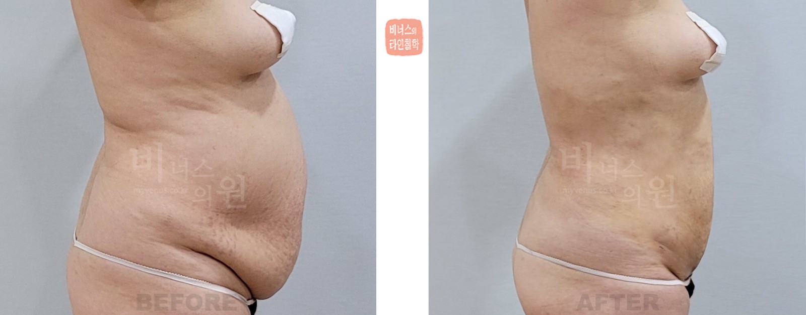 늘어진 복부 지방흡입 전후사진 우측면 (수술 후 12일)