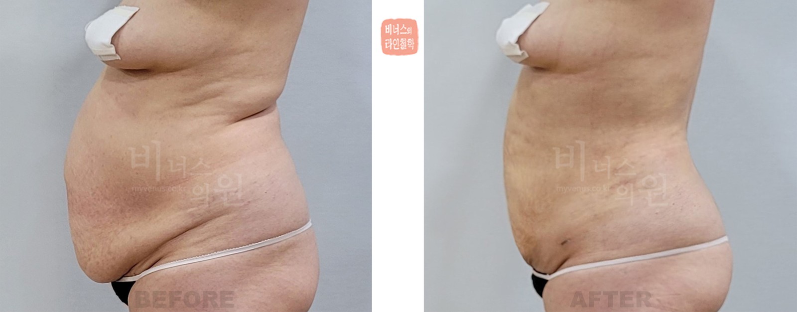 늘어진 복부 지방흡입 전후사진 좌측면 (수술 후 12일)