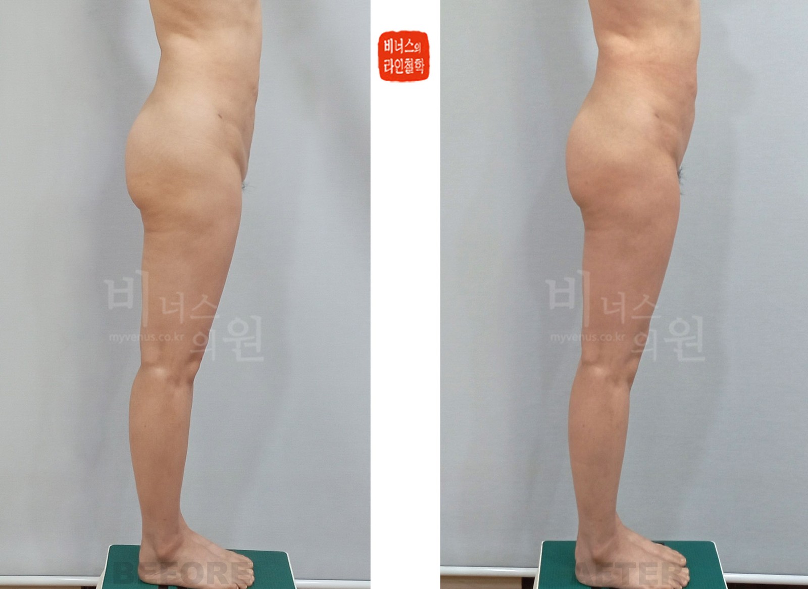 불균형비만 Y존 지방흡입 전후사진 두 번째 케이스 측면 (수술 후 1주일)