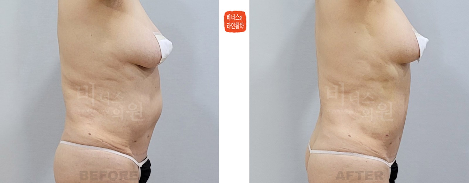상복부 지방흡입 재수술 전후사진 우측면 (수술 후 1주일)
