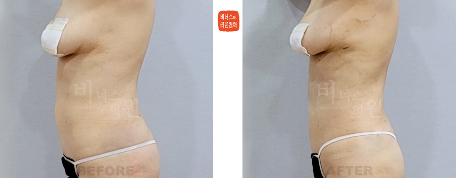 상복부 지방흡입 재수술 두 번째 케이스 전후사진 좌측면 (수술 후 1주일)