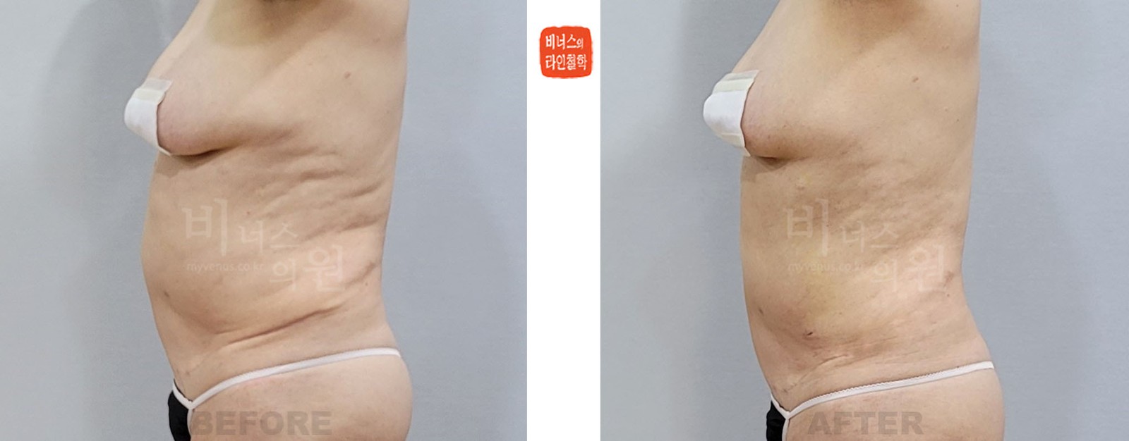 상복부 지방흡입 재수술 전후사진 좌측면 (수술 후 1주일)