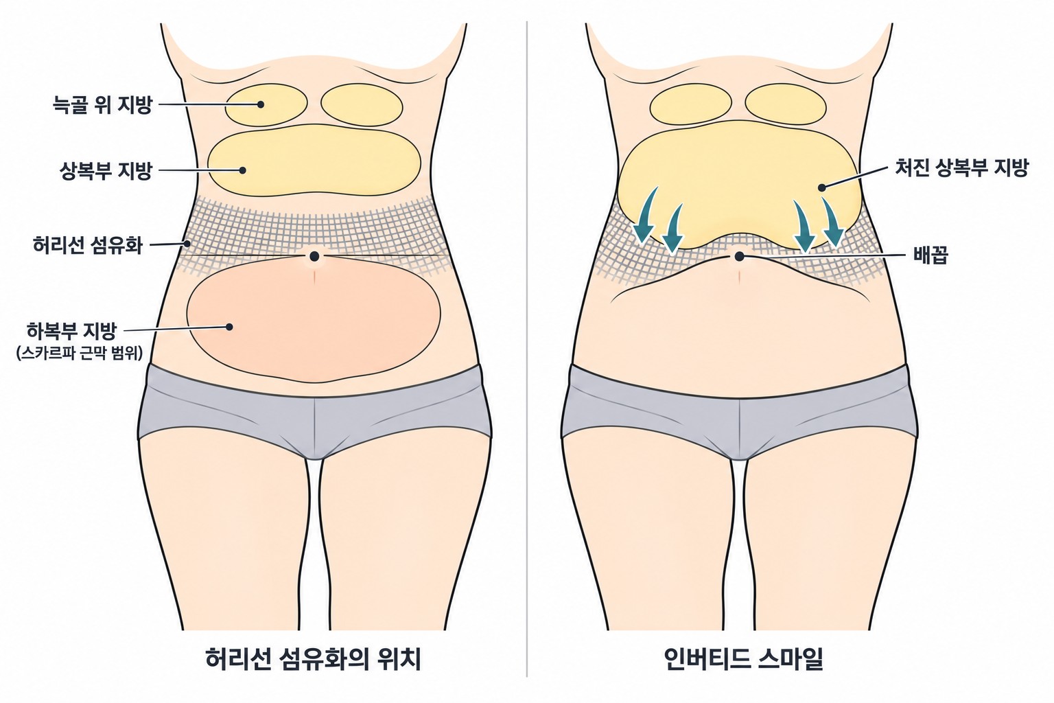 허리선 섬유화의 위치와 인버티드 스마일 모양이 생기는 원리 모식도