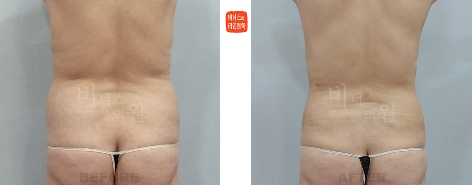 360도 원통형 모래시계 복부 지방흡입 전후사진 후면 (수술 후 1주일)