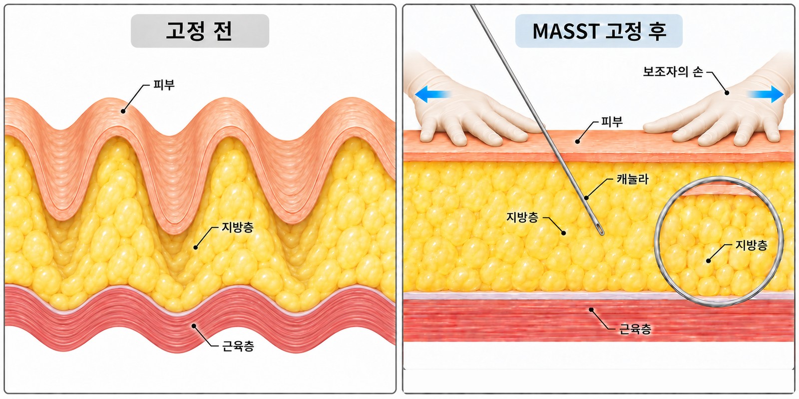 MASST 단면도 — 커튼처럼 출렁이는 지방층을 보조자가 손으로 평평하게 펴 고정하는 원리