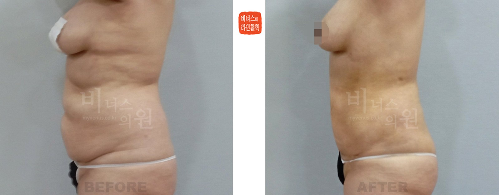 360도 원통형 모래시계 복부 지방흡입 전후사진 측면 (수술 후 1주일)