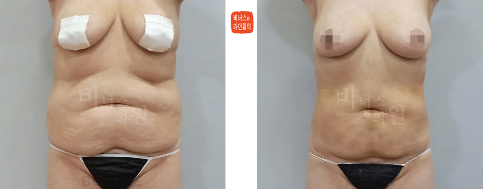 360도 원통형 모래시계 복부 지방흡입 전후사진 정면 (수술 후 1주일)